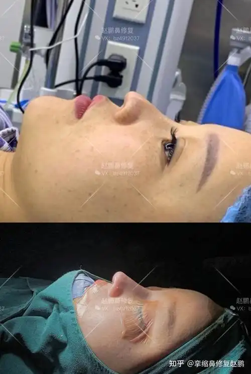 鼻小柱凹陷鼻翼缘退缩修复案例分享