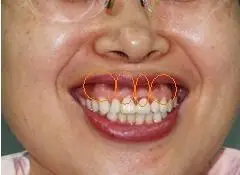 牙槽骨上的骨凸点,口腔医院哪个科可以磨除或切除?