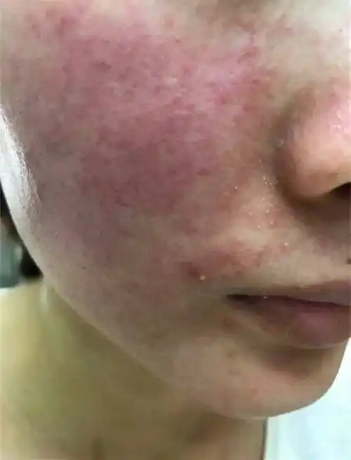 还有一种情况就是面部患有皮肤病,很多皮肤病会伴有瘙痒感,患者不能