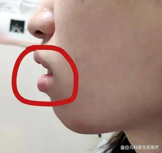 过敏性鼻炎 腺样体肥大,这点小毛病把家长整焦虑了