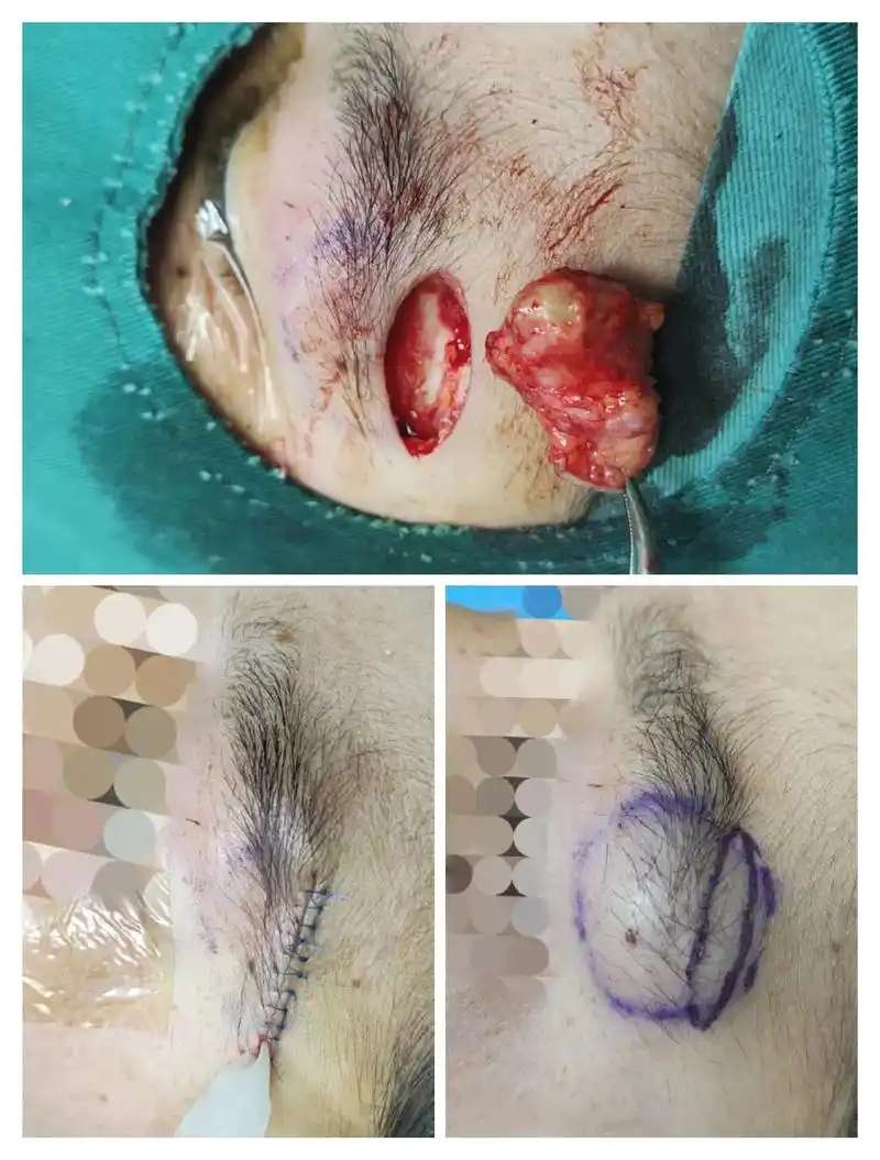 面部表皮囊肿切除术#医学科普 #皮肤科 #皮肤科医生#表皮样 - 抖音