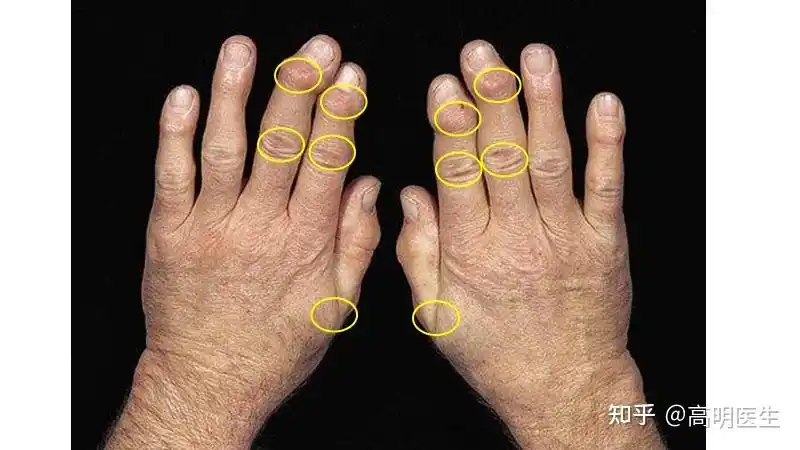 中老年人手指关节疼痛肿胀畸形,一定是类风湿性关节炎吗? - 知乎