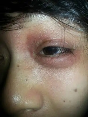 眼睛红了,,很痛,,还起一些小泡泡,,有点肿,会不会是细菌感染了,,擦