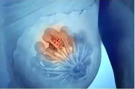 粉红十月女性乳房有这几种形态要警惕了