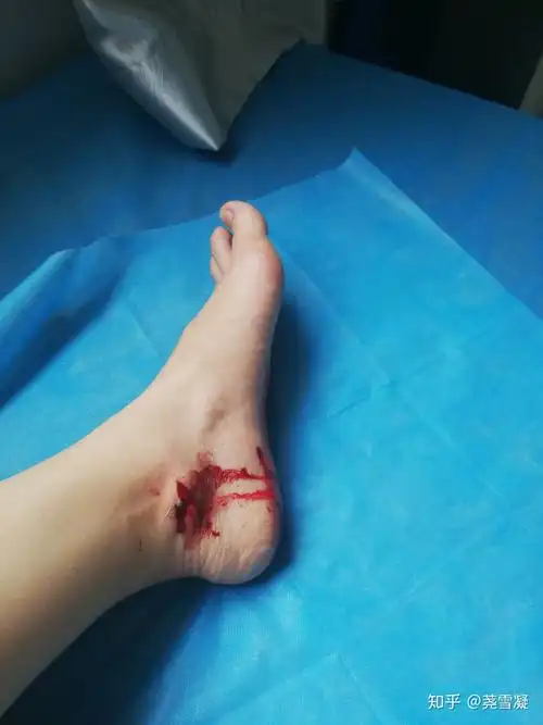 外伤缝针! - 知乎