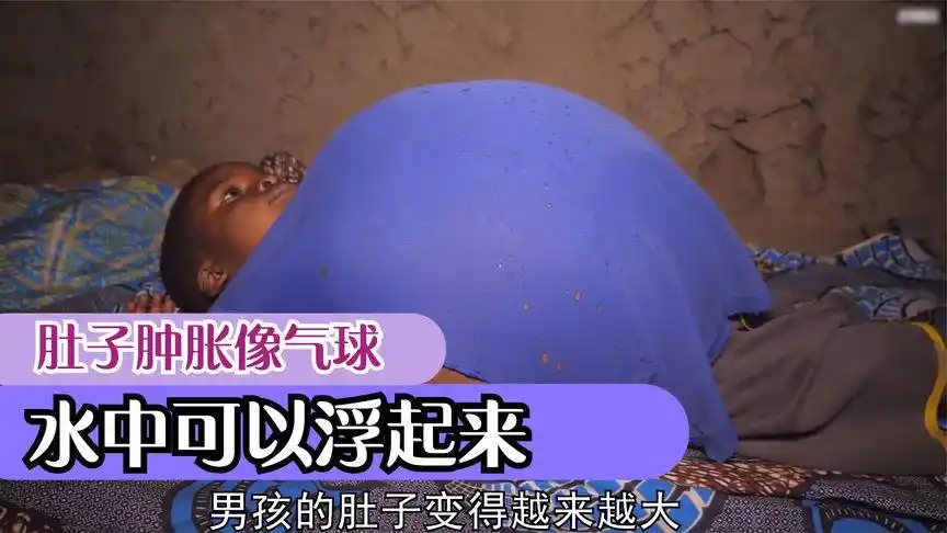 男孩肚子肿胀像气球,摔倒就站不起来,水中洗澡可以浮