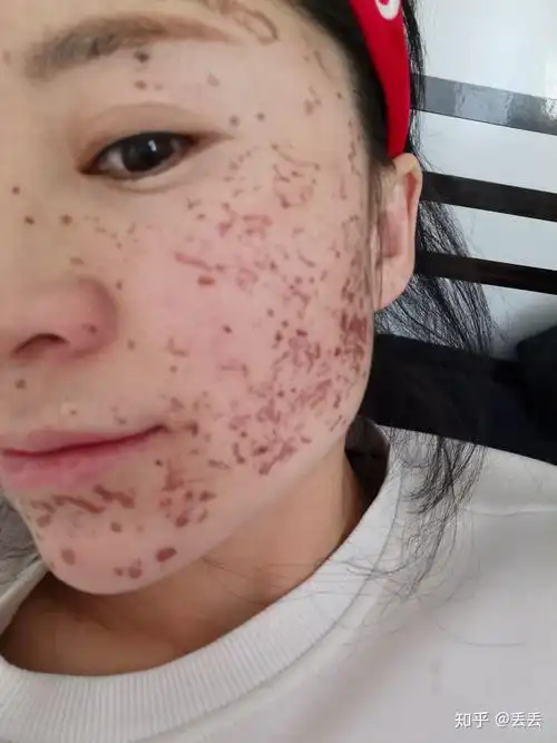 药水祛斑 - 知乎