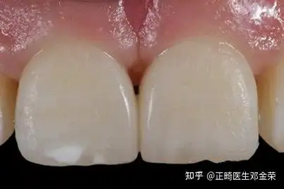 你有没有发现,你的牙齿缝隙越来越大? - 知乎