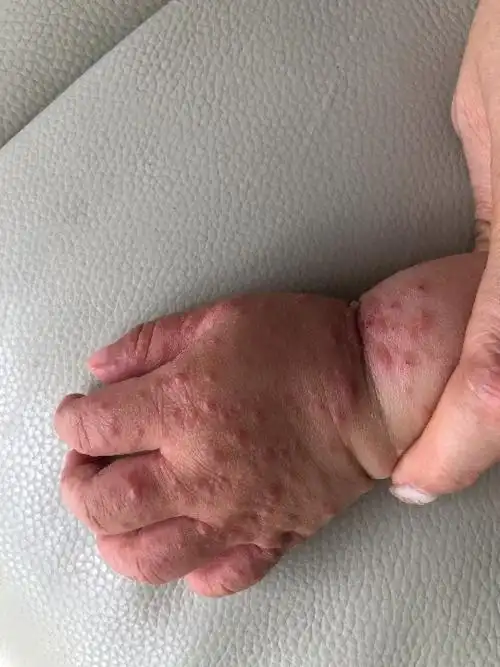 皮疹严重的手足口