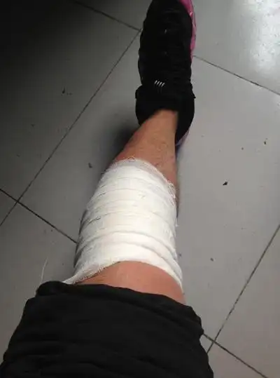 真实腿部受伤图片 (25)_有来医生