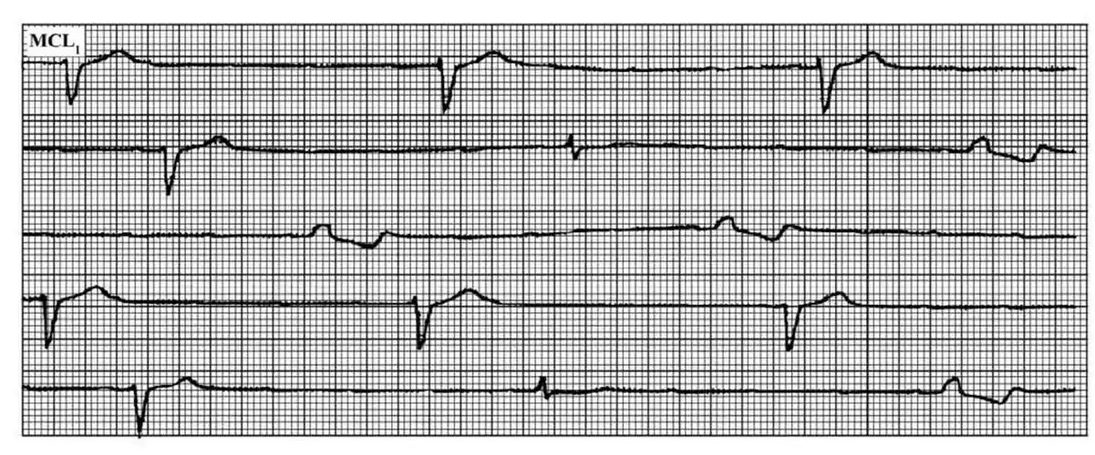 心电图长间歇伴心电特殊现象的解析