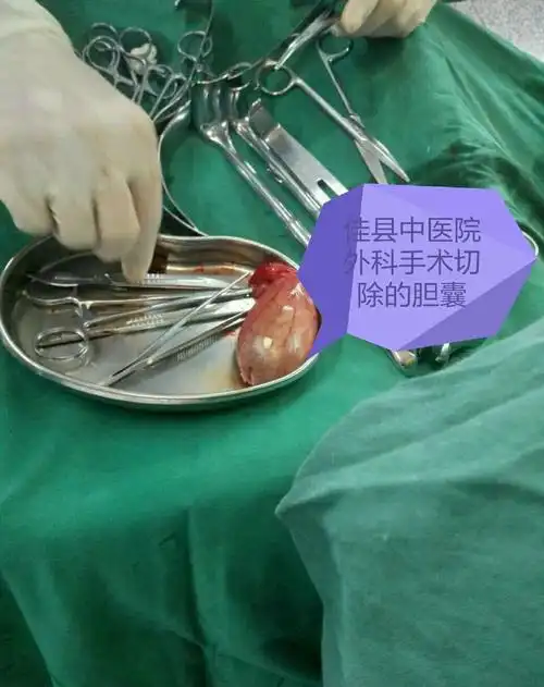 胆囊结石(息肉)不是"小病",应及时手术,以防癌变