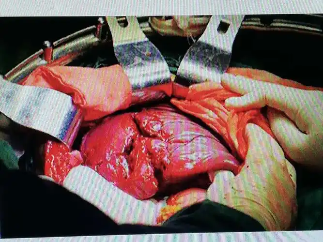 一位重症肝破裂病人的惊险处理过程 - 美篇