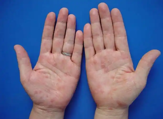手掌和足底发出无症状性红色斑疹首先要排除梅毒