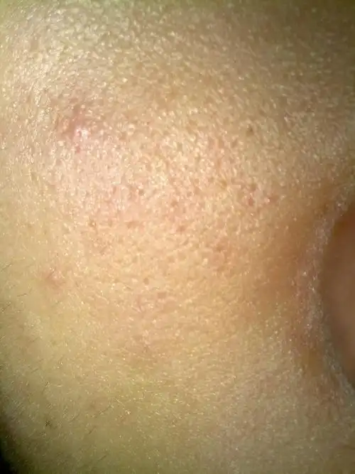 脸上毛孔有点大 怎么整?推销的别来 我怕(如图)