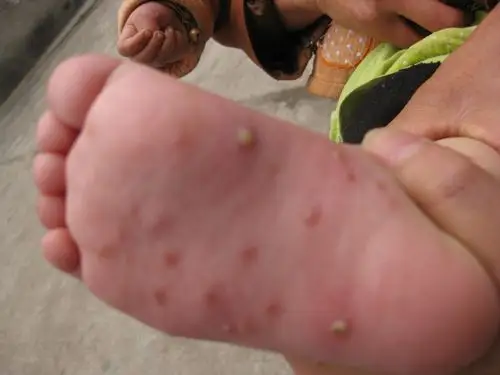 手心 手背近腕部  双下肢 及 足心 可以见到红斑 丘脓疱疹