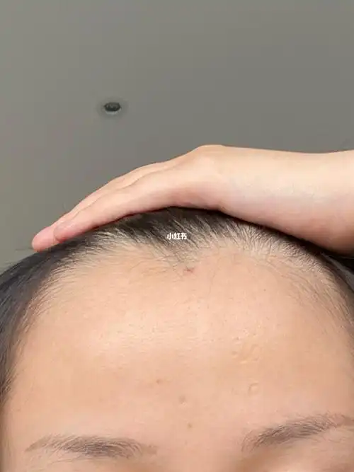 剃光头到现在3个月_生发_发际线_时尚_发型