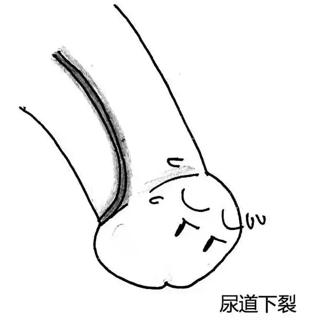 "南楠"说科普|男宝宝总爱蹲着尿?可能是尿道下裂!(上篇)