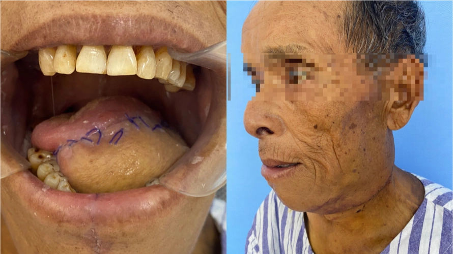 我院成功为口腔鳞癌患者切除肿瘤