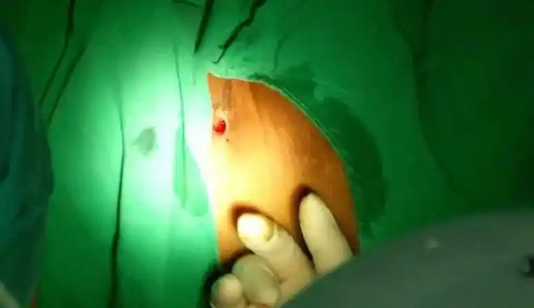 "肛瘘手术到底有多痛?_陈先生_大便_医生