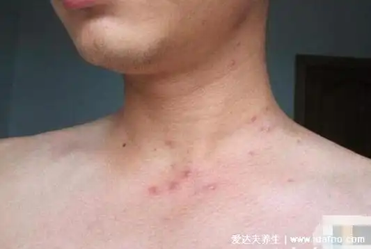初期艾滋病全身图片,什么样的小红点是艾滋(附自查法)