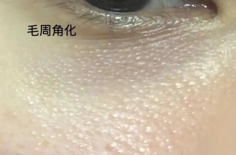 眼下很多这种白色小粒粒,感觉不像脂肪粒,请问到底是什么? - 知乎