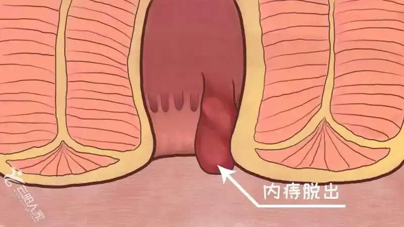 为什么有的痔疮疼,有的不疼?