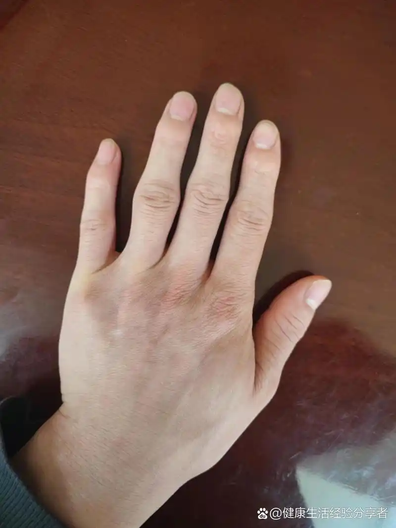 21岁得了关节炎,类风湿,看看你们的手 2021年,1月在新疆哈密,在哈密的