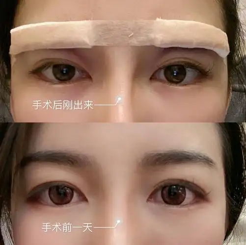 全网最真实切眉分享,我不是托,也不推荐医院