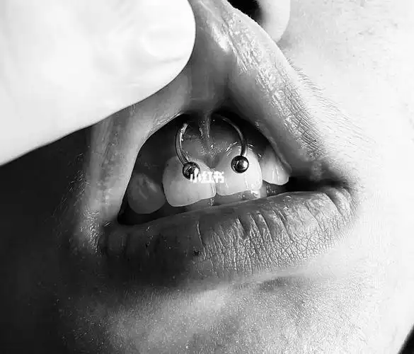 微笑钉牙系带穿刺工作