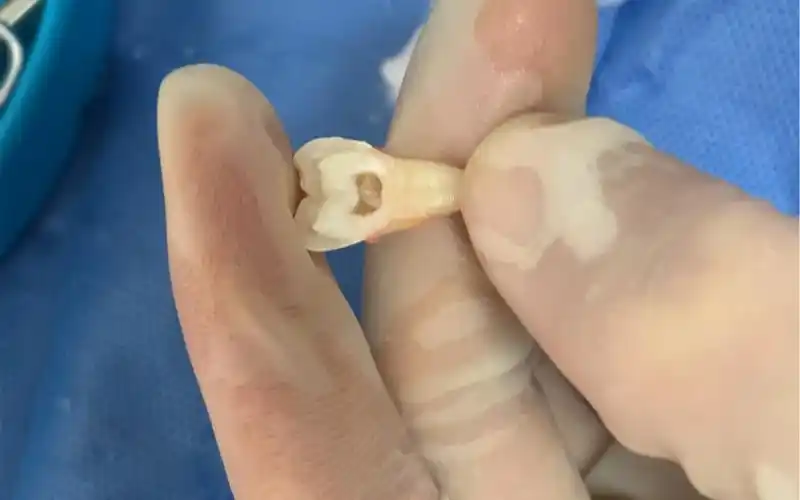 传说中的牙髓牙神经