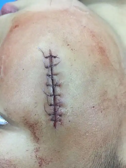 外伤整形美容缝合 - 好大夫在线