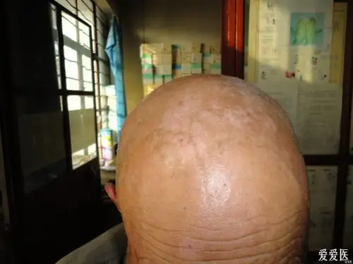 颈部神经性皮炎的治疗 - 皮肤及性传播疾病讨论版 - 爱爱医医学论坛