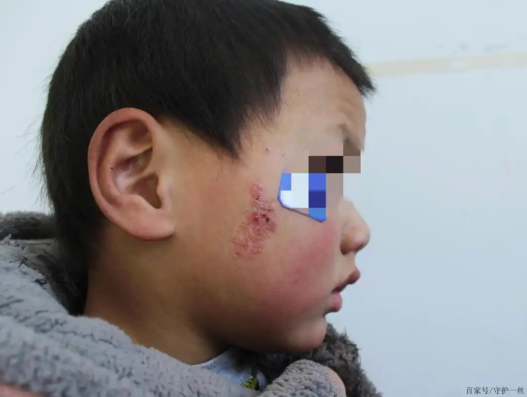 4岁男孩面部疯涨的皮脂腺痣