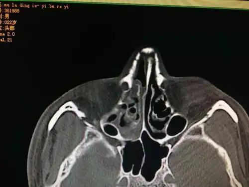 一例严重的鼻骨粉碎性骨折手术复位分享