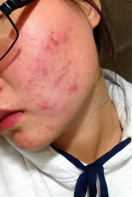 有青春期痤疮,痘痘的朋友可以加我微信了解,经过我们多次调理的病症