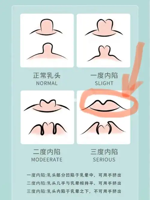 因为大家都告诉我,生了娃自己就好了;但是没有人告诉我,乳头内陷会