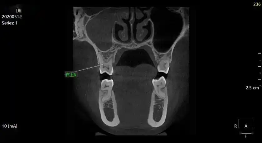 李xx20200512上颌窦炎ct158xxxx0907