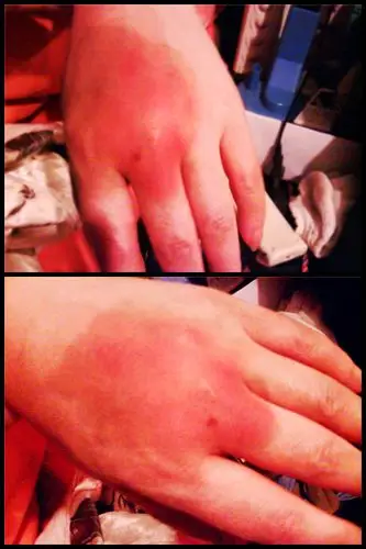 医生,母亲的手背突然红肿了,痛得厉害,急!