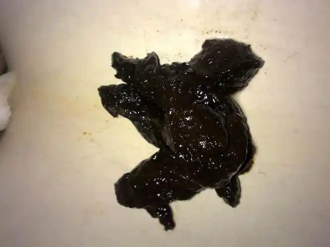 大便发黑是什么原因