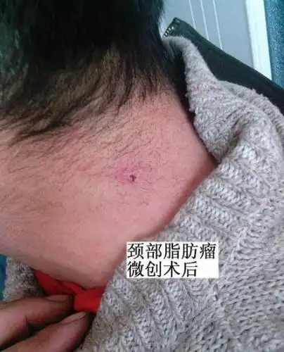 微创消融技术 去除脂肪瘤