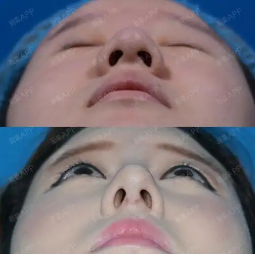 鼻小柱过宽过短凹陷歪斜应该怎么叫矫正呢