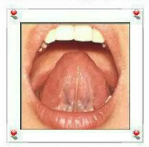 正常舌下静脉是隐约可见的细细的两根血管,三十岁以前,基本是不明显的