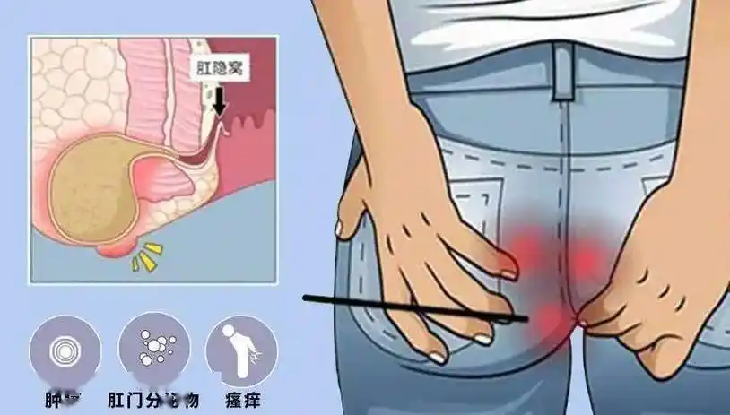 肛门周围的皮肤和软组织容易受到细菌的侵袭,导致感染和脓肿的形成.
