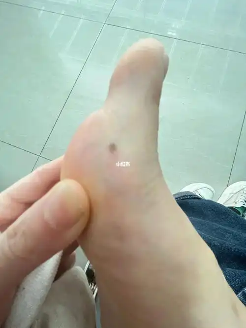 脚上长痣