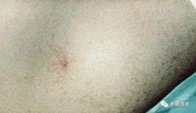 肝癌早期,皮肤先知!皮肤上若有4个"表现",八成是肝癌"上门"