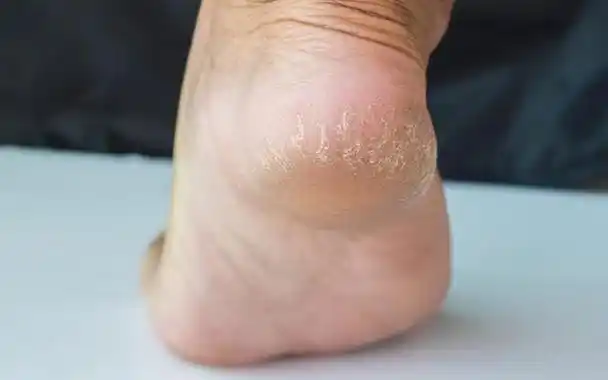 吃的多,喝的多,尿的多,体重减轻,这是糖尿病典型的早期症状,然而有些