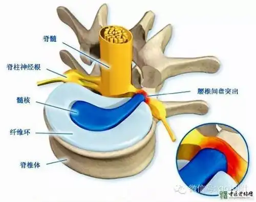 脊柱伤:最多的就是椎间盘突出,伴随一些腰椎骨由于急性运动导致的骨折