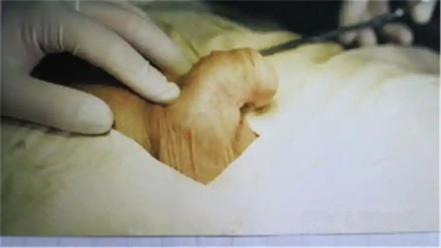 尿道下裂变性图片_有来医生