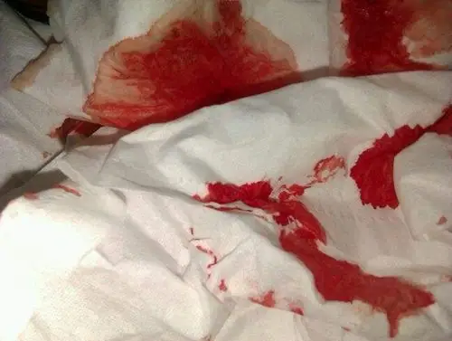 吐血图片 (3)_有来医生